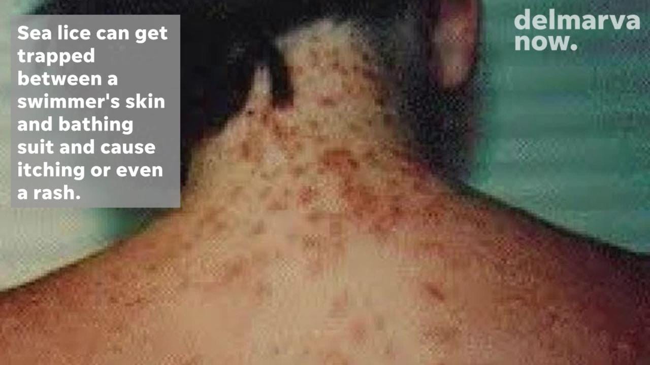 swimmers itch from ocean
