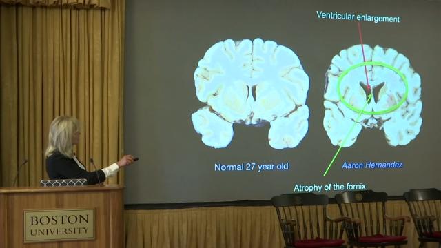 SportsReport: Aaron Hernandez Brain Scan Finds Advanced CTE