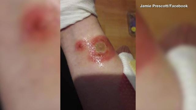 mother-warns-about-child-s-2nd-degree-burns-from-deodorant-challenge