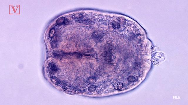 Parasite In Womans Spine Causes Tingling Sensation Trouble Walking 