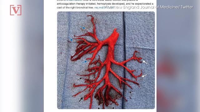 NEJM shares odd photo of blood clot shaped like lung. A man spit it up