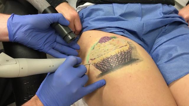 Why PicoSure Is the Best Way to Get Rid of Unwanted Tattoos: Richard  Blanchar, MD: General Practitioner